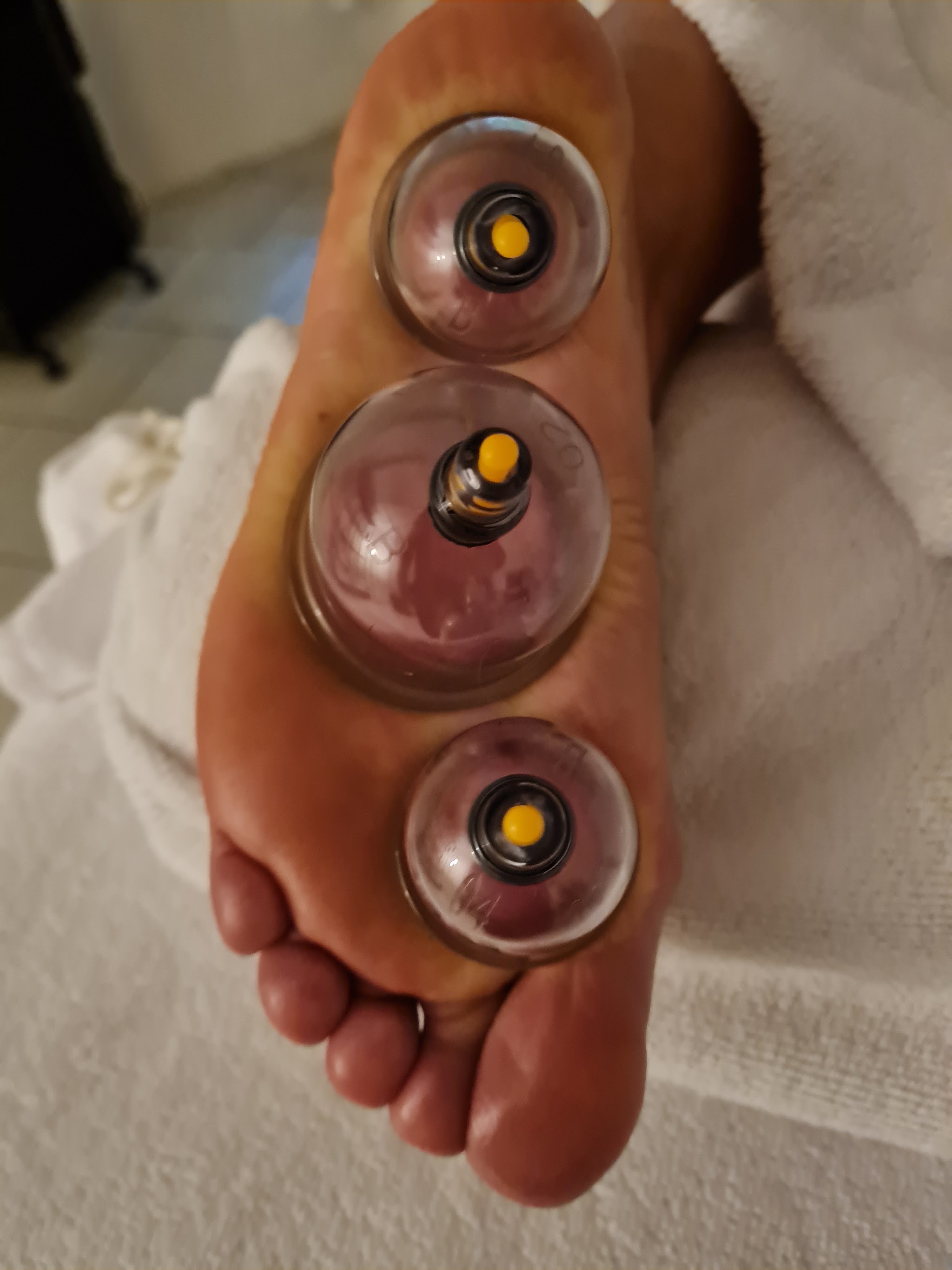 Drie glazen cups op de voetzool tijdens een cuppingbehandeling